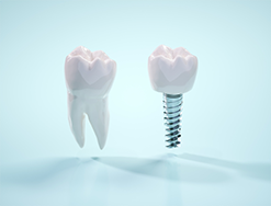普通の歯とインプラントの歯