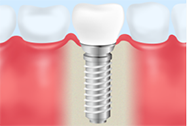 インプラント