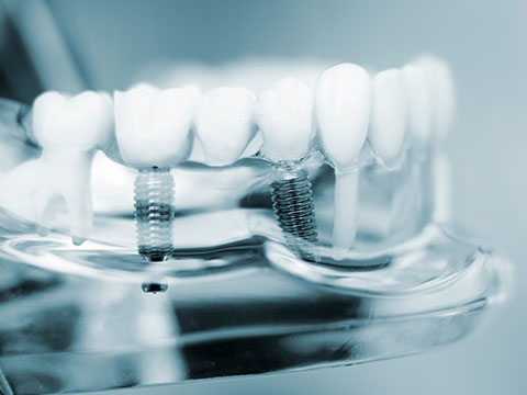 歯を失ってしまった場合の治療法「インプラント」