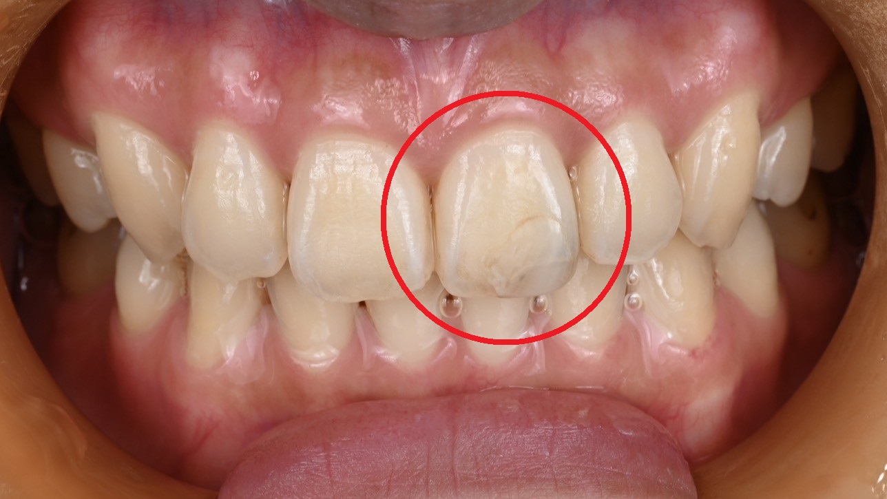 20代女性 前歯のラミネートベニア