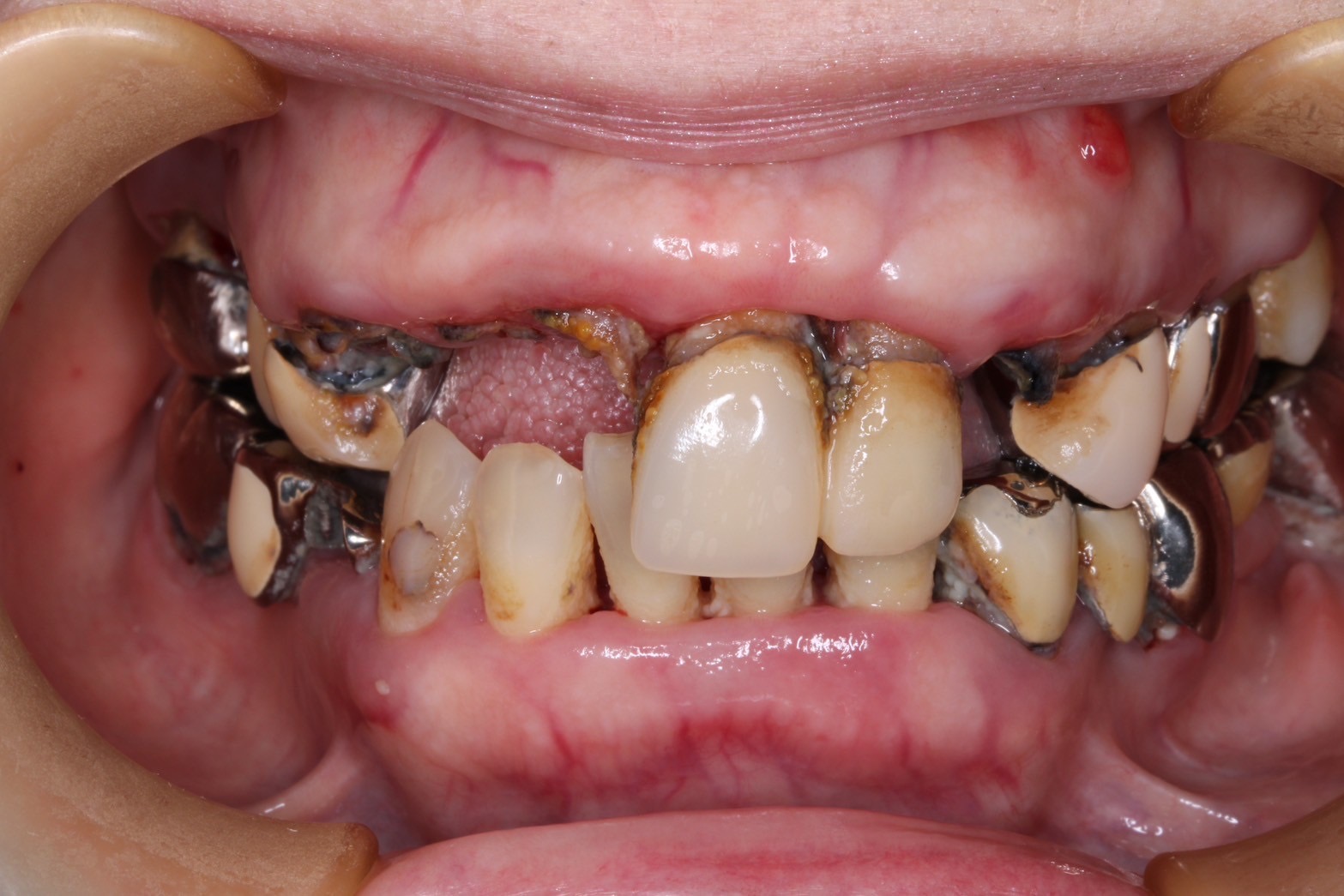 前歯　セラミック症例