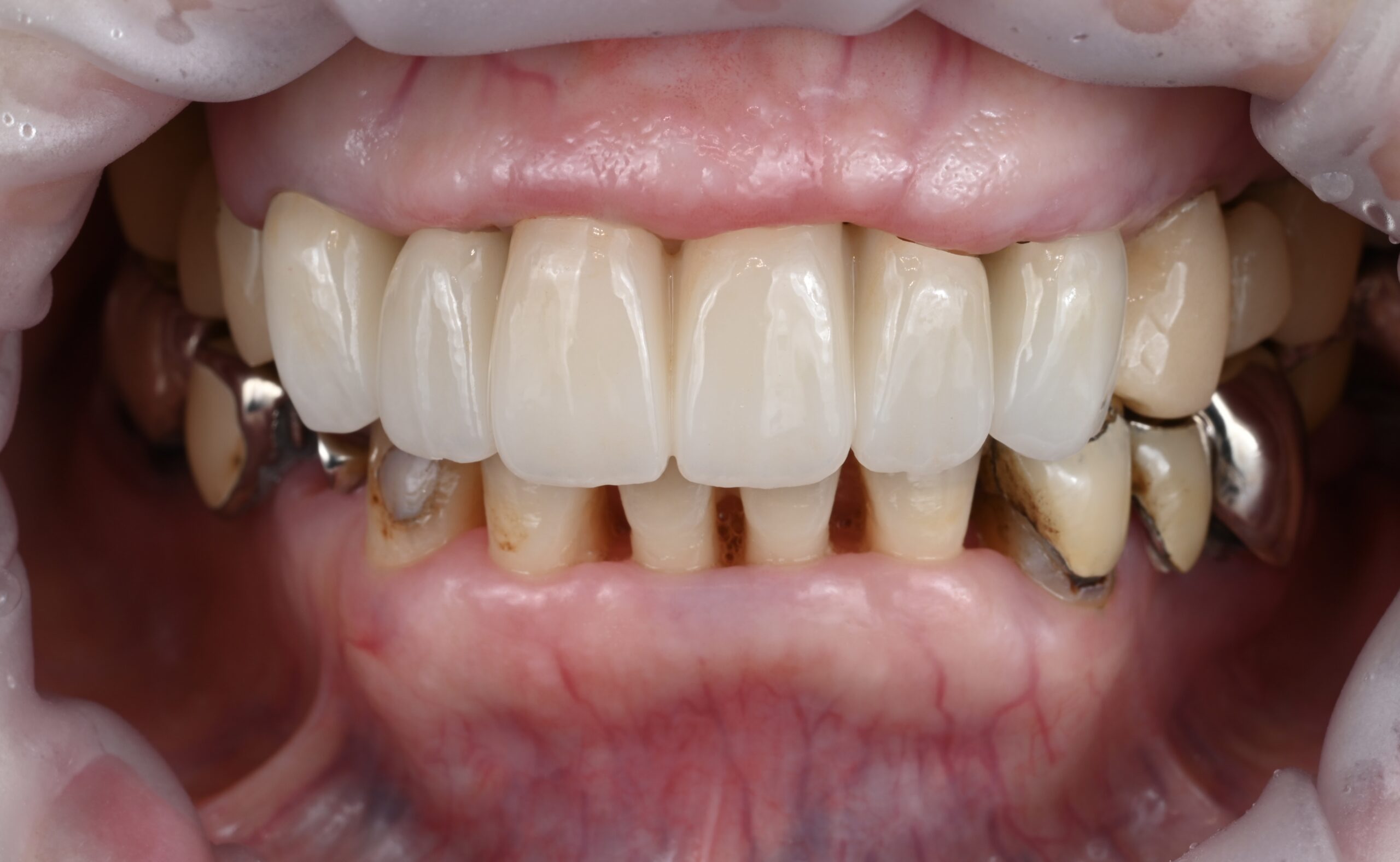 前歯　セラミック症例