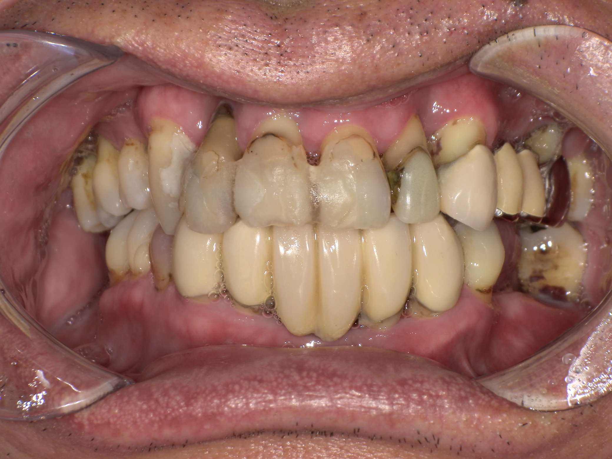 インプラント治療(All on 4)