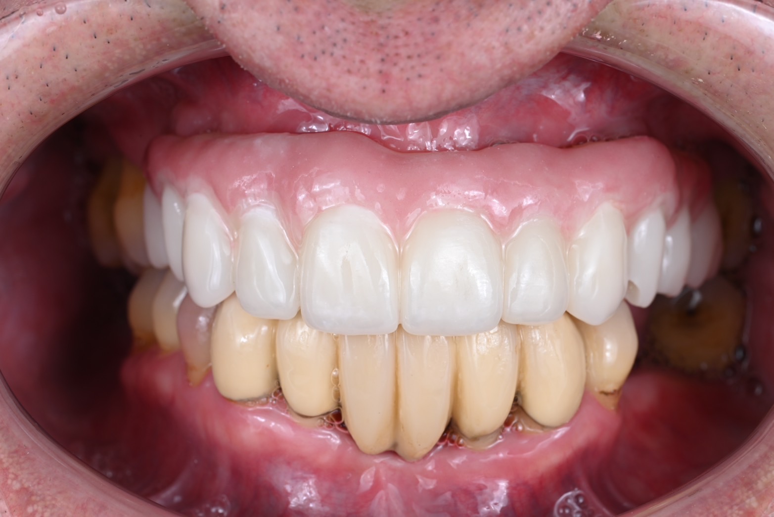 インプラント治療(All on 4)