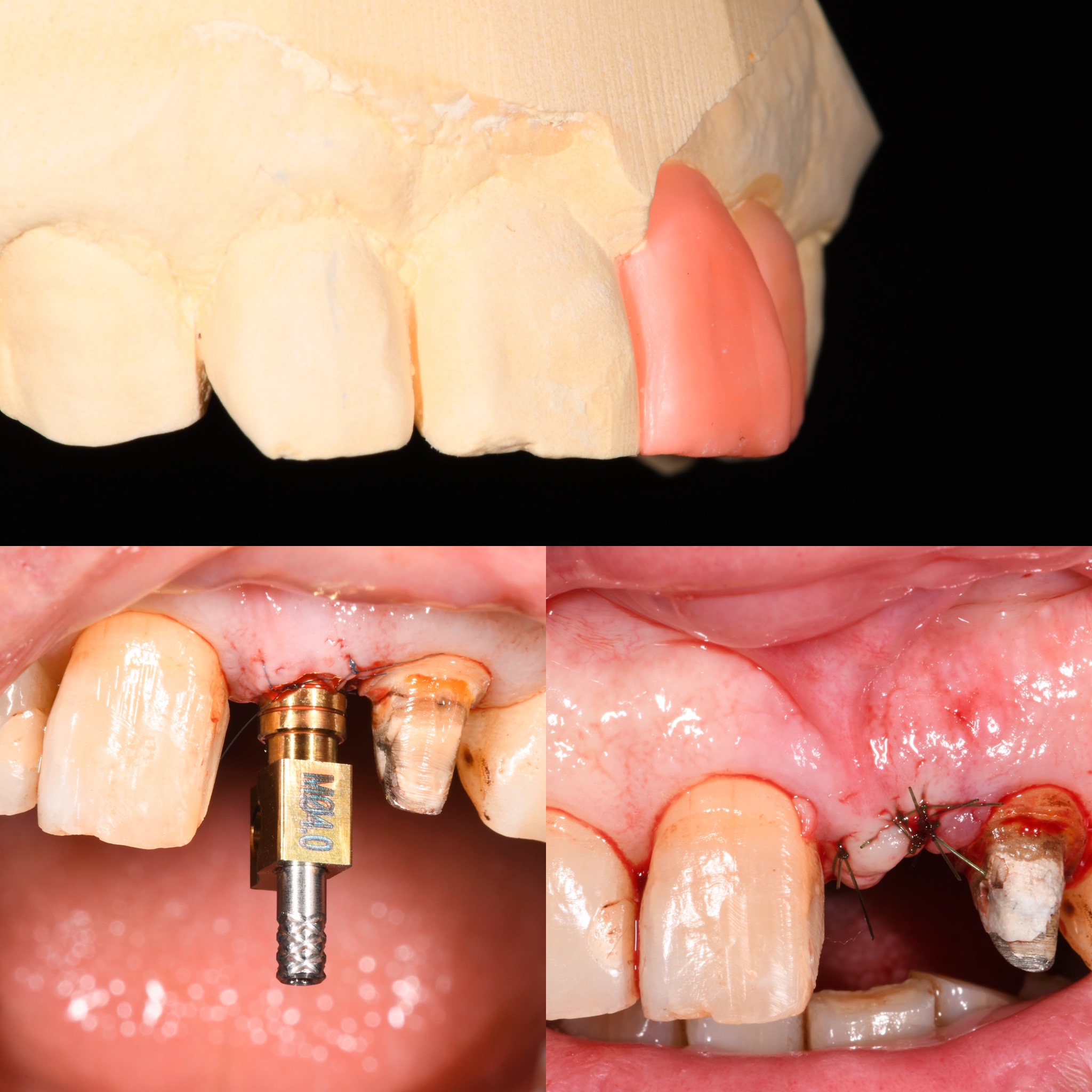 インプラントの寿命