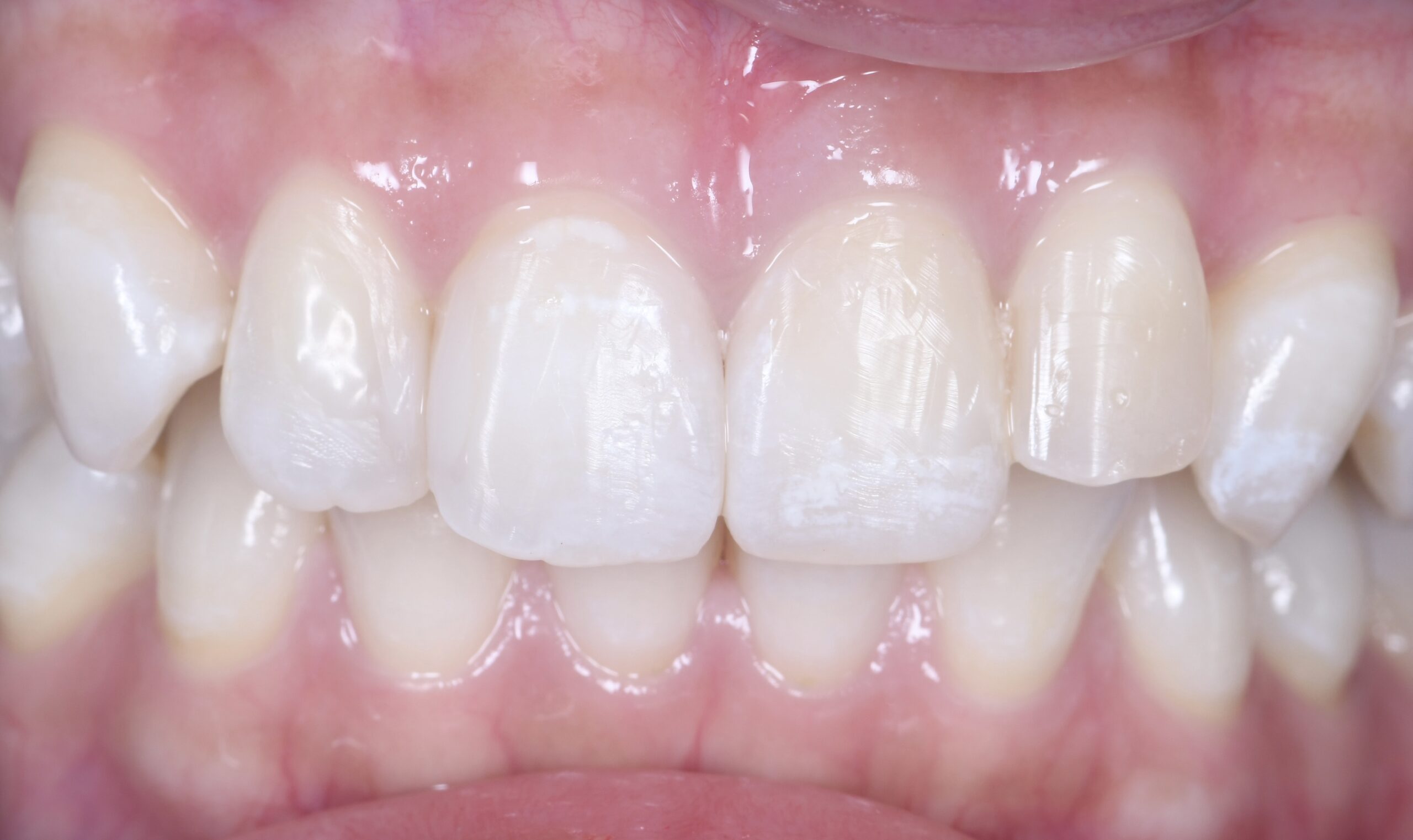 ダイレクトボンディングによる即日修復治療