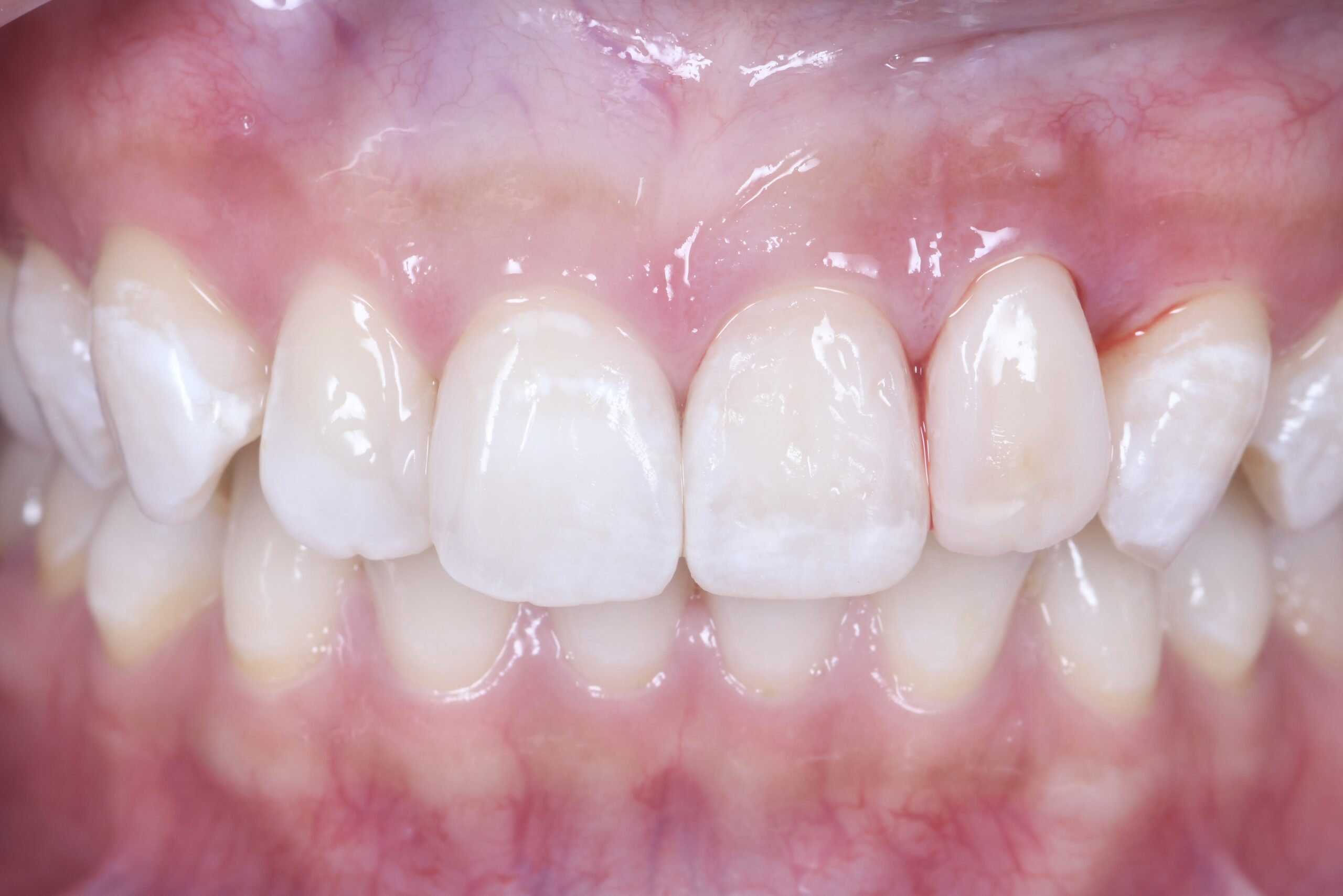 ダイレクトボンディングによる即日修復治療