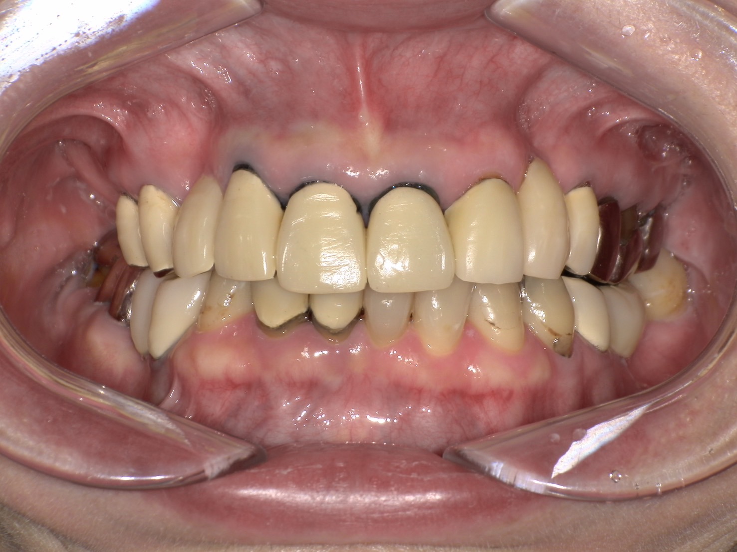 審美インプラントケース