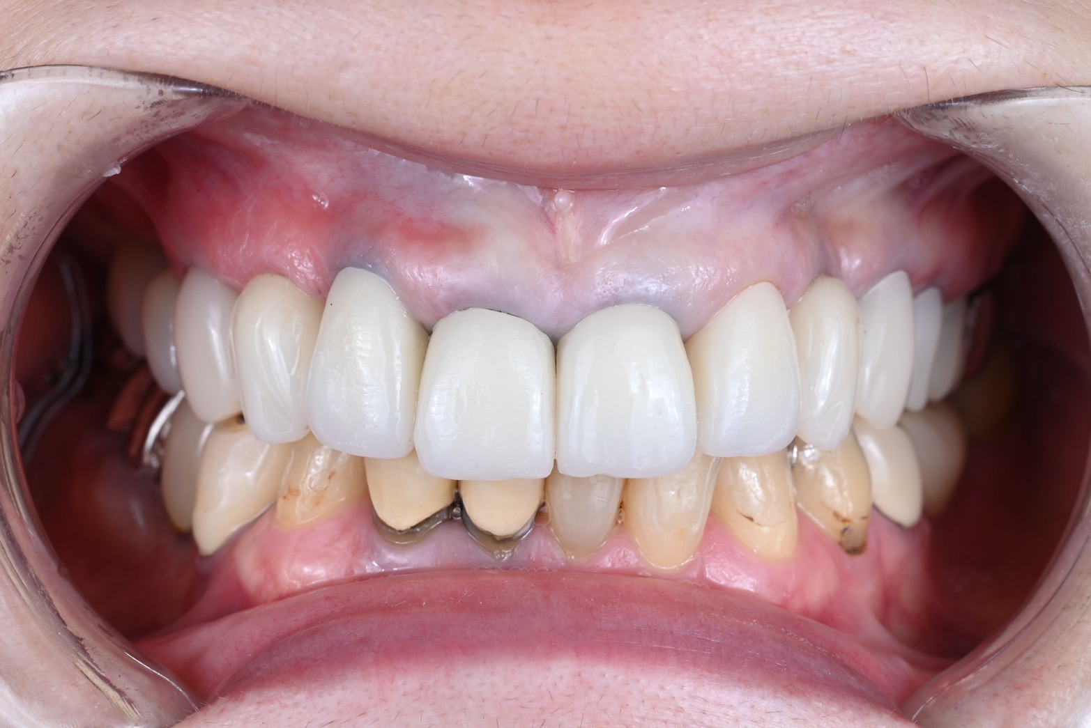 審美インプラントケース