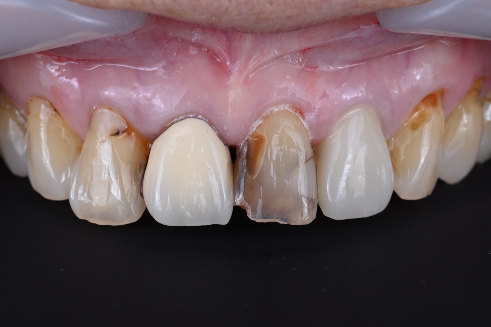 前歯審美ケース