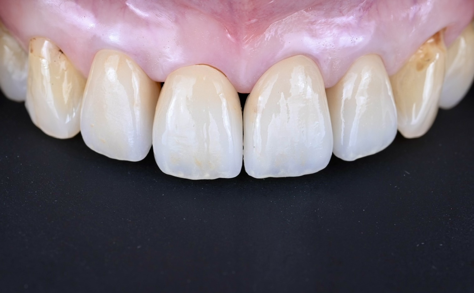 前歯審美ケース