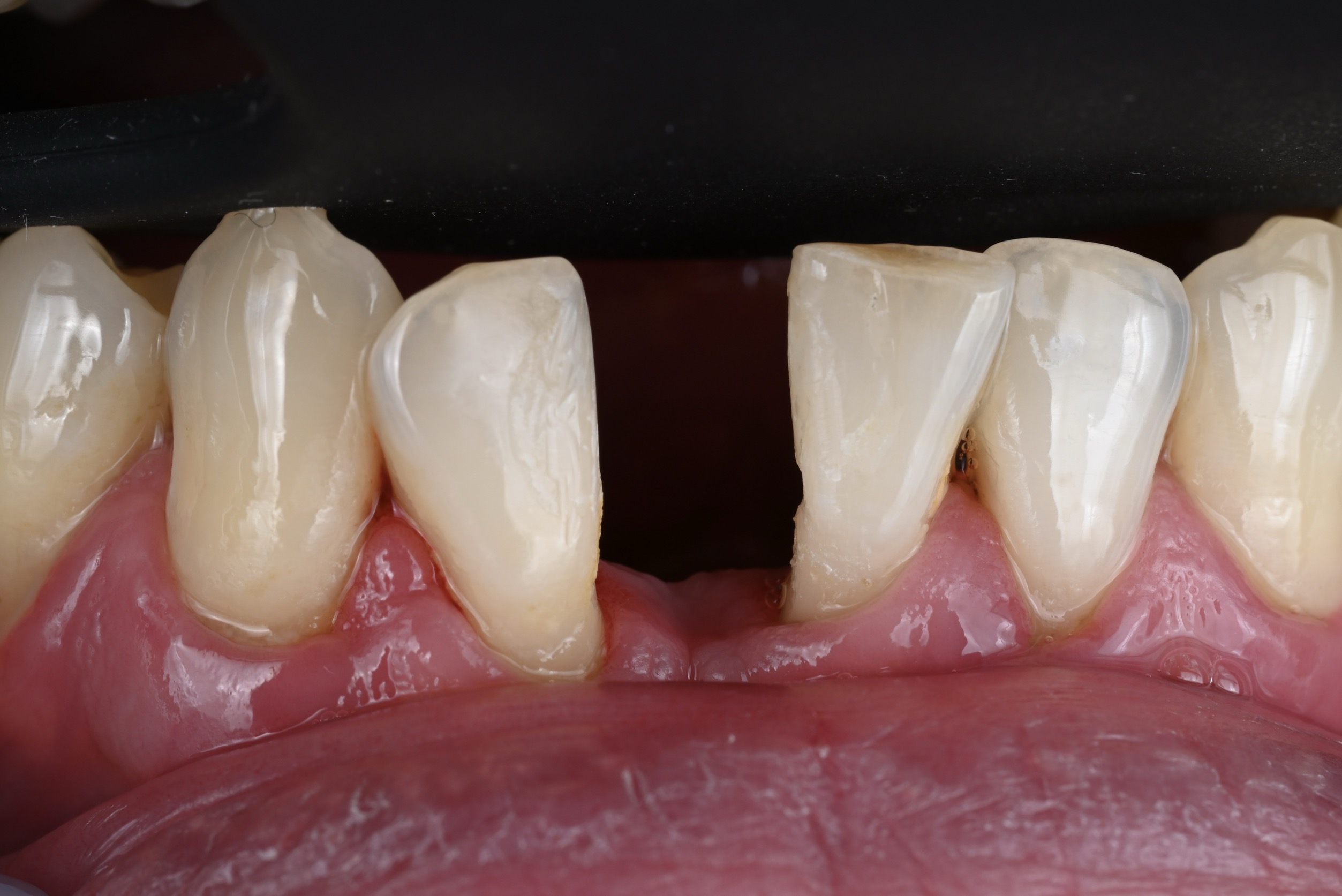 下顎前歯インプラントケース