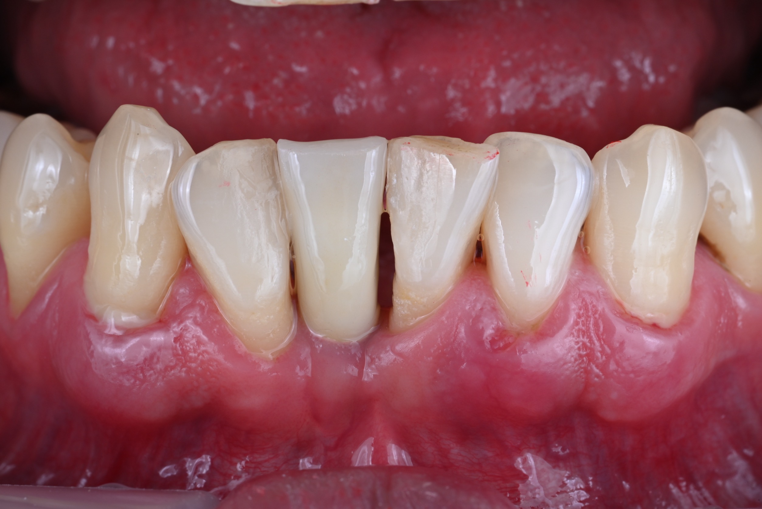 下顎前歯インプラントケース