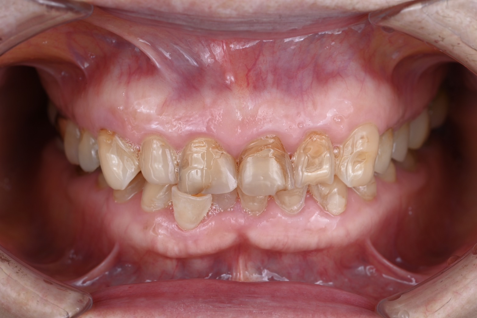 フルマウスケース