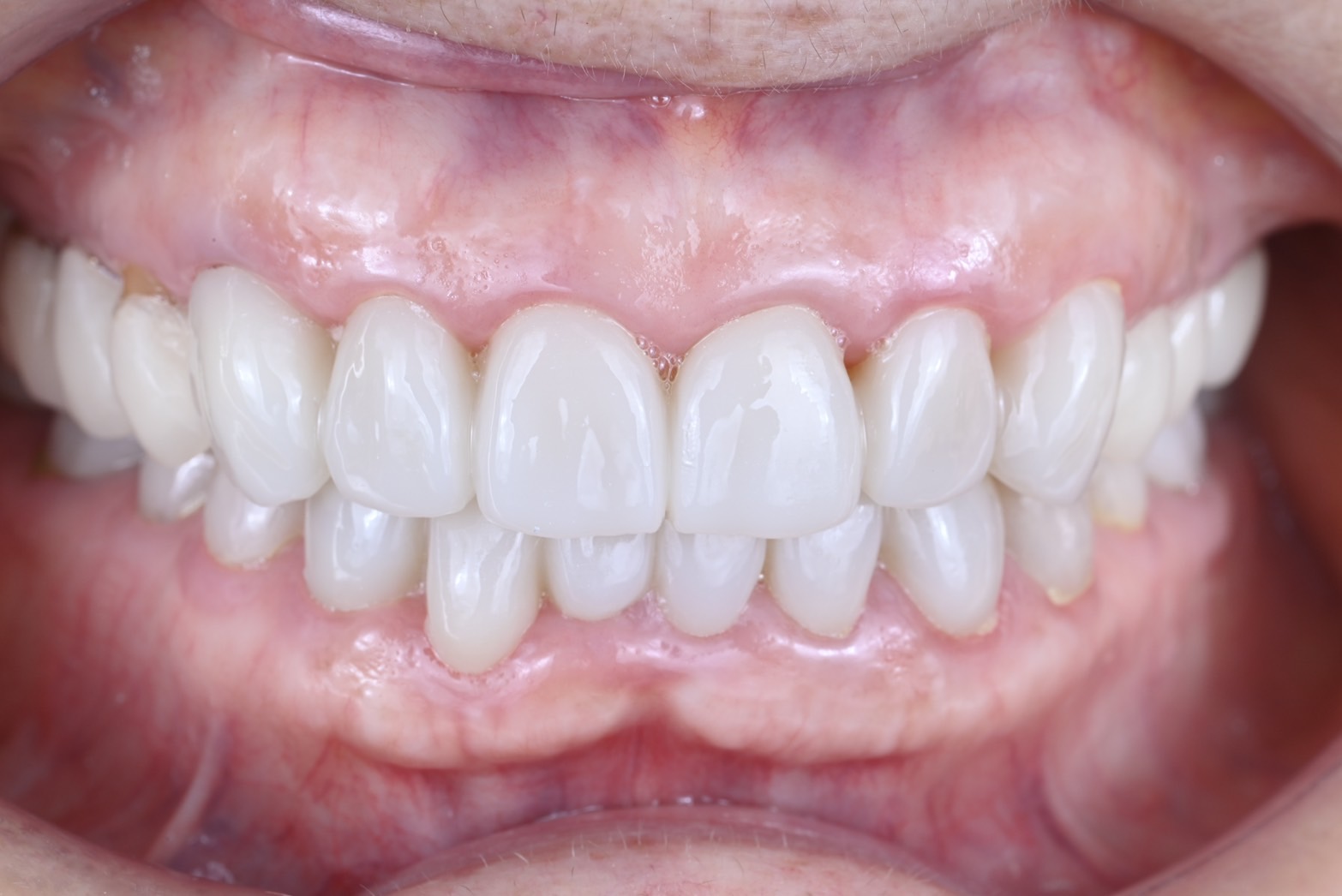 フルマウスケース