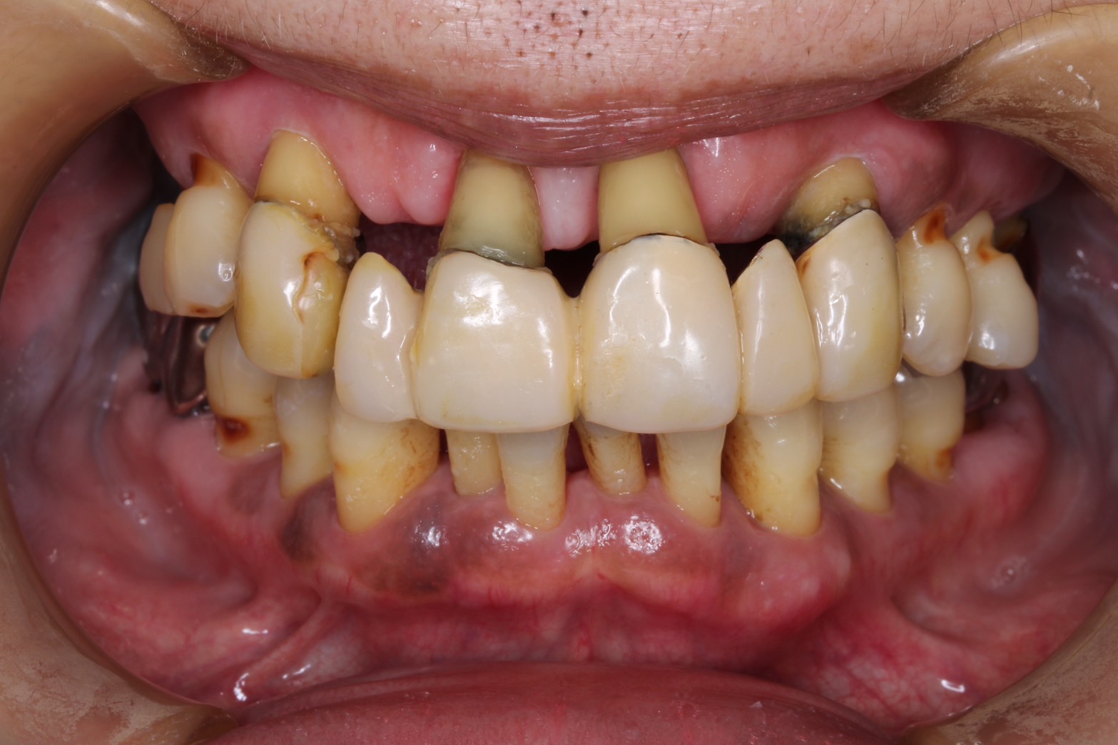 前歯インプラントケース