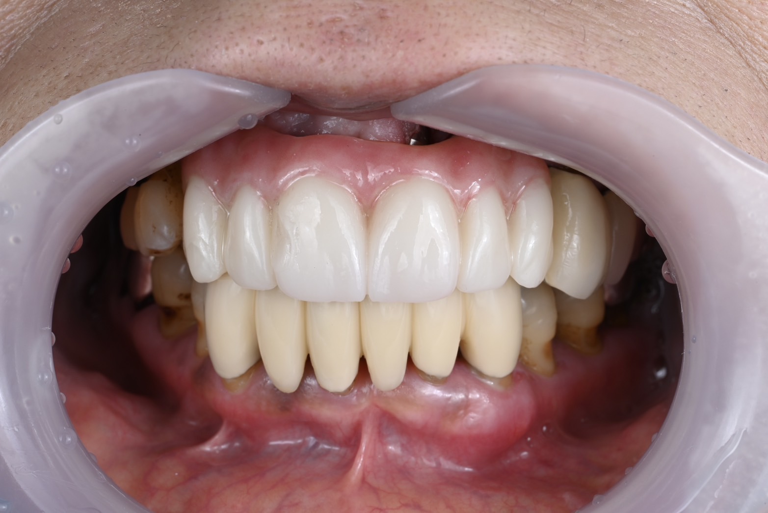 前歯インプラントケース