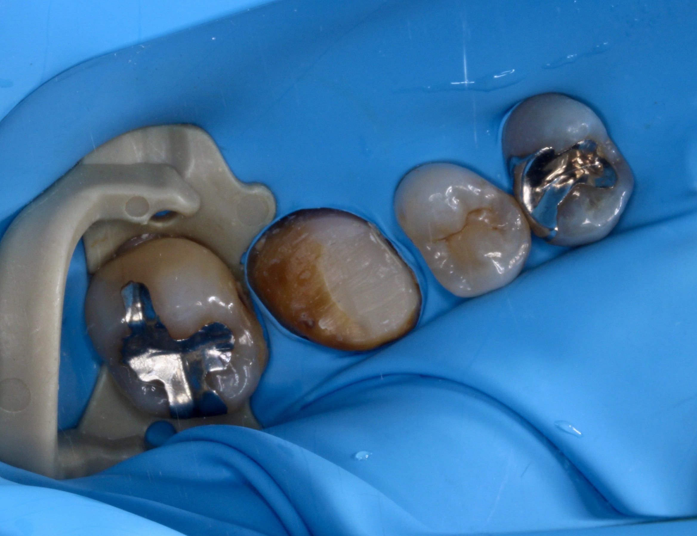 臼歯のダイレクトボンディング症例