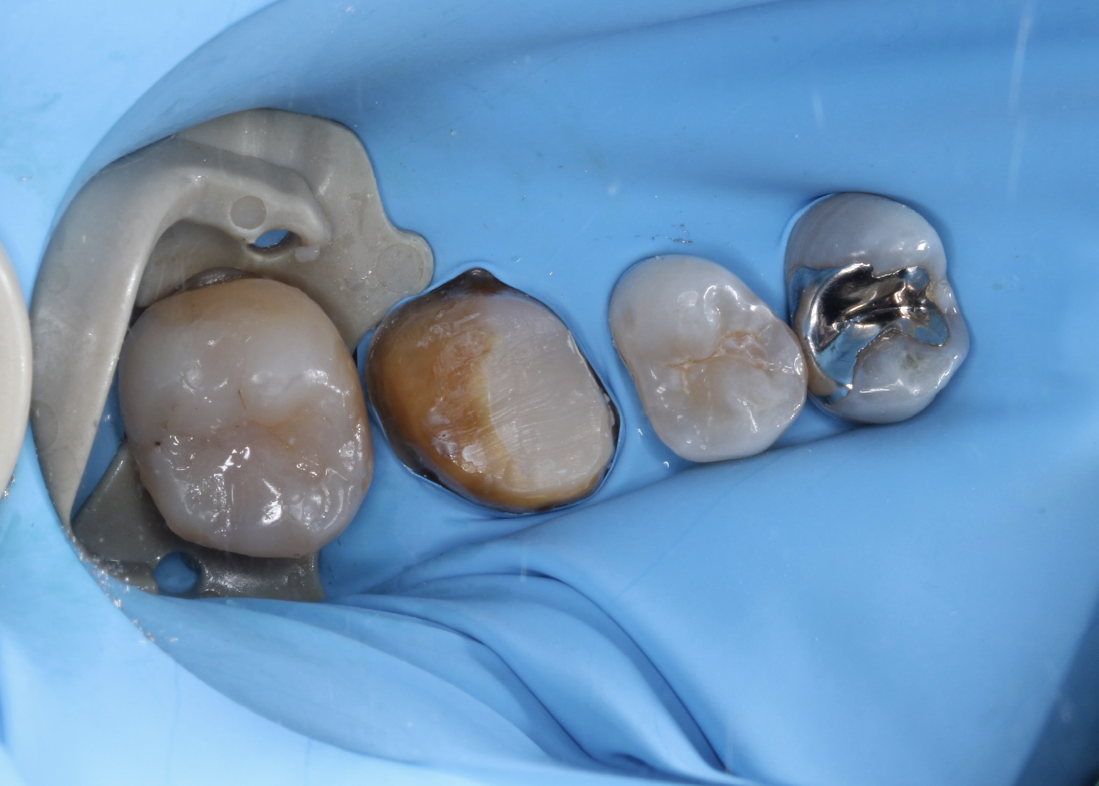 臼歯のダイレクトボンディング症例