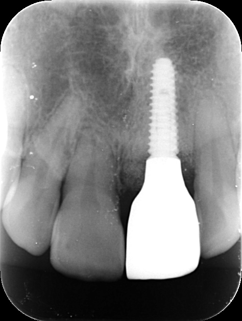 インプラント治療のメリットデメリット